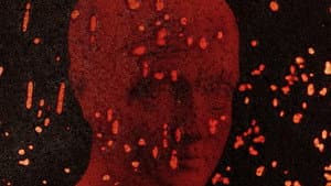 Pigment-Dispersion Syndrome — foto 9